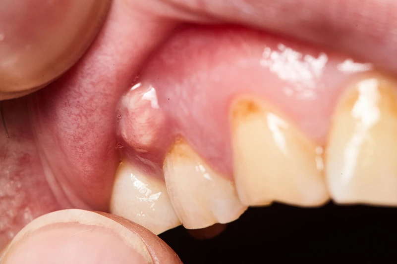 abscess tooth