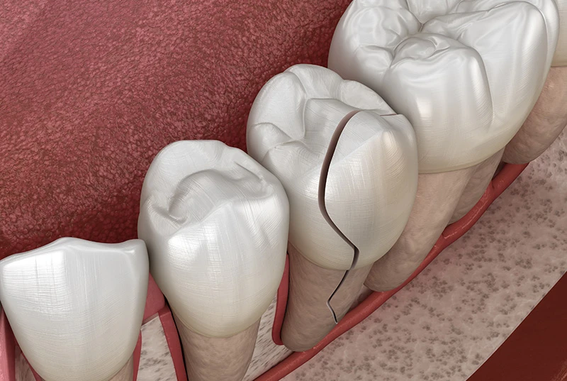cracked tooth
