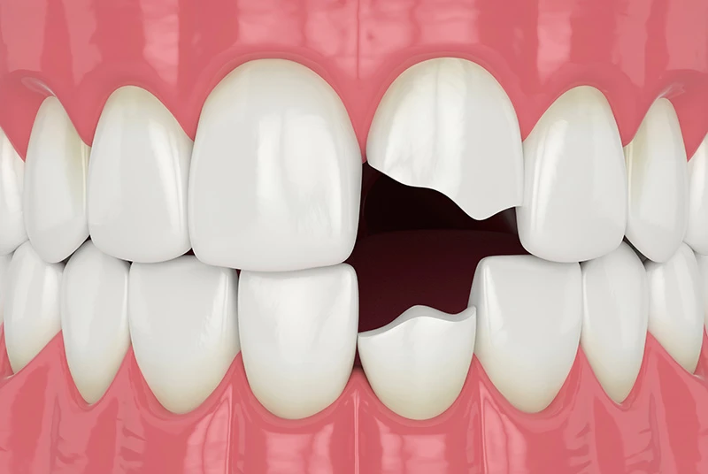 knocked out tooth