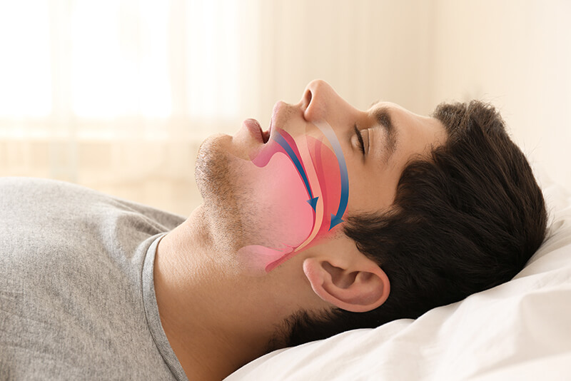 sleep apnea